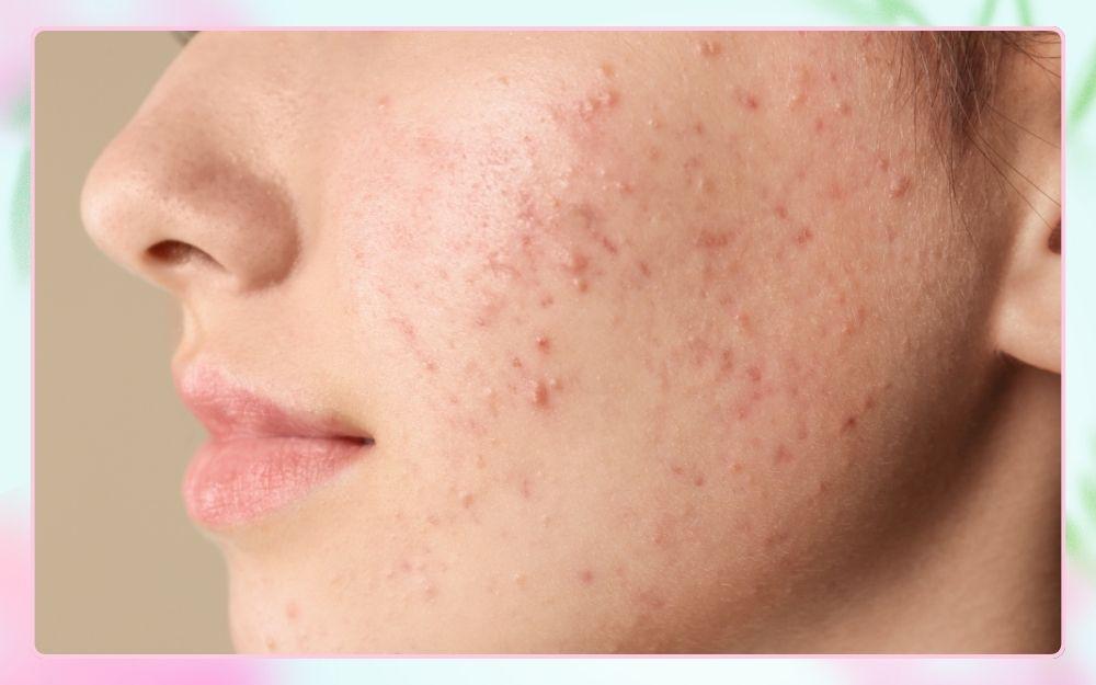 Hướng dẫn chăm sóc da mụn đúng cách và những điều cần biết