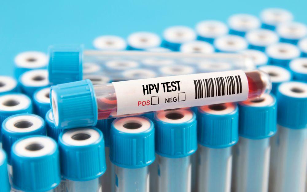 Có cần xét nghiệm virus HPV trước khi tiêm vắc xin HPV không?
