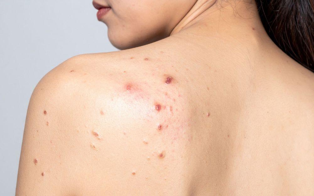 7 nguyên nhân gây mụn lưng ở nữ giới và cách khắc phục
