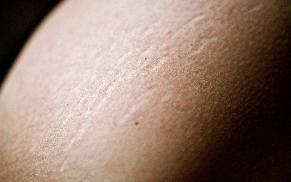 Cách trị rạn da hiệu quả và những lưu ý khi thực hiện